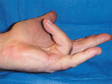 A Dupuytren kontraktúra egyre jobban korlátozza az érintett ujj mozgását