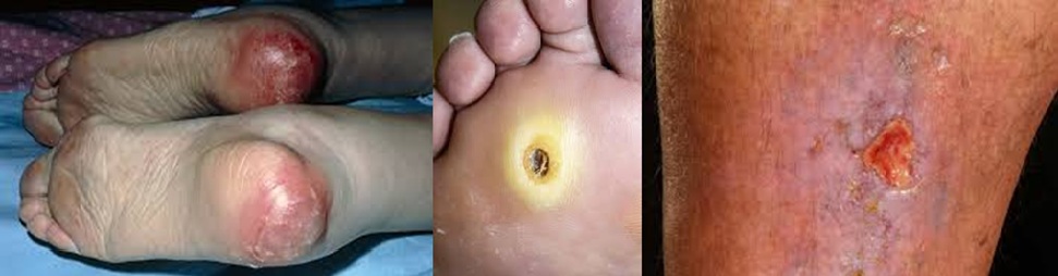 Ózon terápia a fekélykezelésében