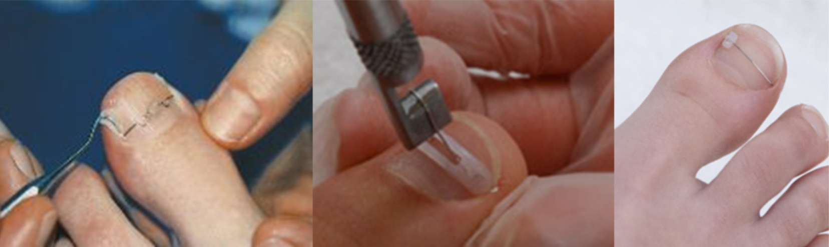Pedikűr (Speciális-Gyógy) – Lábápoló Komplett képzés | Profession Nails