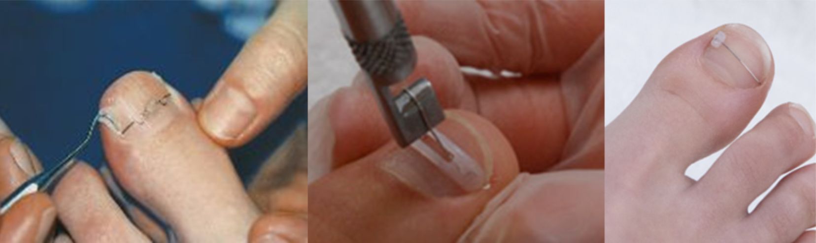 Fellevegősödött köröm-onycholysis