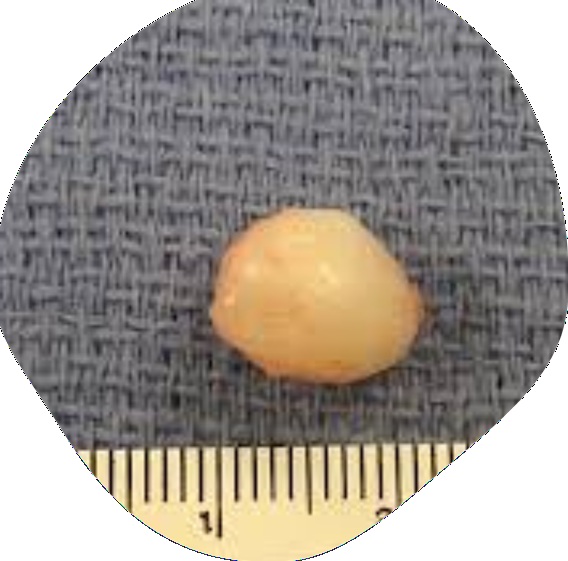 Tokkal együtt, egyben eltávolított atheroma