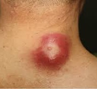 Gyulladt kásacsomó