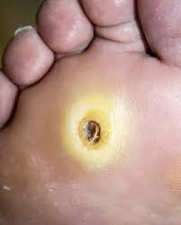 Cukorbetegeknél gyakori a nehezen gyógyuló talpi fekély