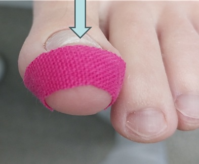 Kineziotape alkalmazása az ujjcsúcsi lágyrész feltorlódásának megelőzésére